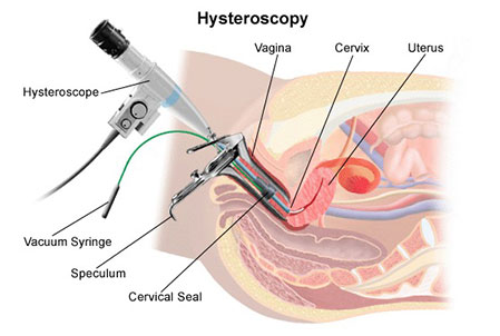 Hysteroscopy photo