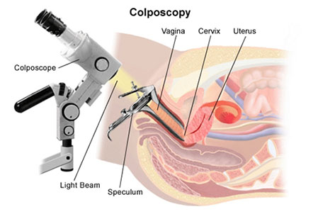 Colposcopy