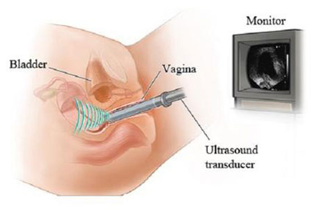 Sonohysterogram