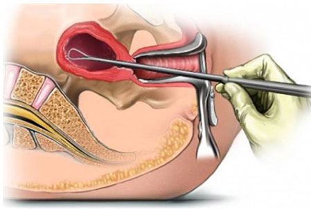 Endometrial Biopsy