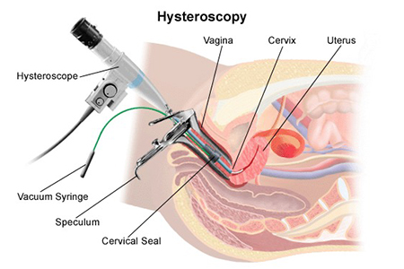 Hysteroscopy/Endometrial Ablation